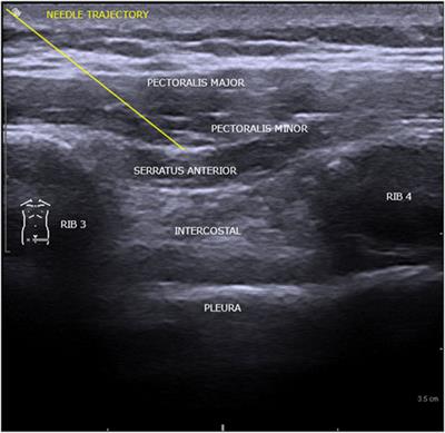 LC-MS/MS assisted biomonitoring of ropivacaine and 3-OH-ropivacaine after plane block anesthesia for cardiac device implantation